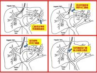 介入科 | 门静脉高压的介入治疗