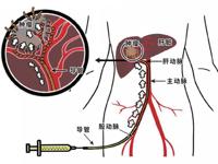 介入科 | 肝癌的介入治疗