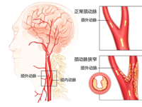 介入科 | 颈动脉狭窄的介入治疗