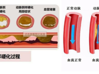 介入科 | 下肢动脉硬化闭塞症介入治疗