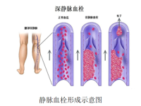 介入科 | 下肢深静脉血栓的介入治疗