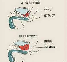 泌尿外科 | 关注男性健康——前列腺增生