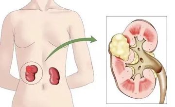 泌尿外科 | 肾癌科普知识