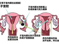 病理科||病理科普——子宫腺肌症